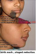 Before after Pictures,Cosmetic surgery,Delhi,birthmarks